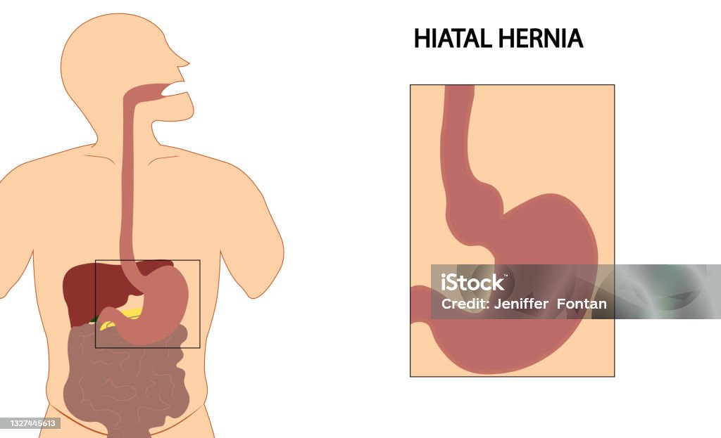 Hiatus hernia. Hiatal hernia. Types of hiatal hernia illustration Hiatus Hernia stock illustration