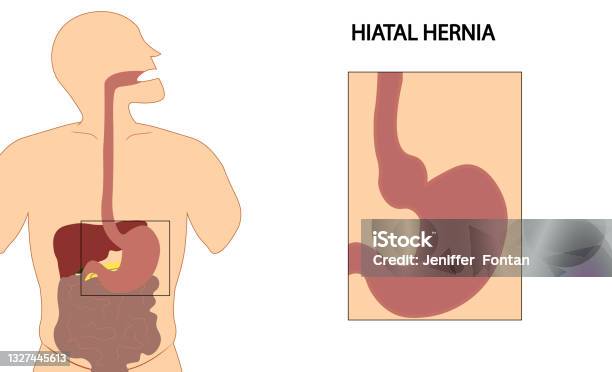 Hiatus Hernia Hiatal Hernia Types Of Hiatal Hernia Illustration Stock Illustration - Download Image Now