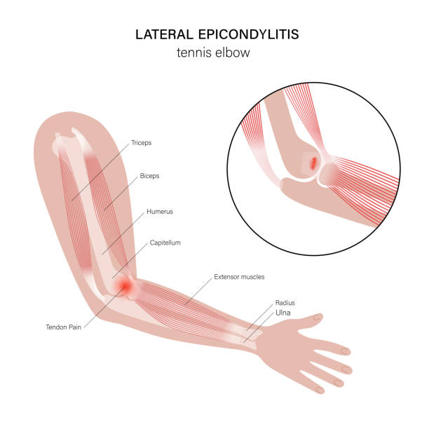 illustrazioni stock, clip art, cartoni animati e icone di tendenza di gomito da tennis epicondilite laterale - human muscle human arm muscular build body building