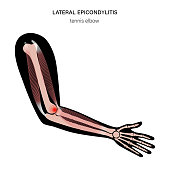 laterale-epicondylitis-tennisellenbogen.jpg?b=1&s=170x170&k=20&c=ZSQEiKMTqULjP4WjMlaLHezi1aBa8rqfeCxb0r7WMyY=