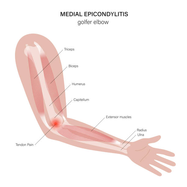 illustrazioni stock, clip art, cartoni animati e icone di tendenza di gomito da golfista epicondilite mediale - human muscle human arm muscular build body building