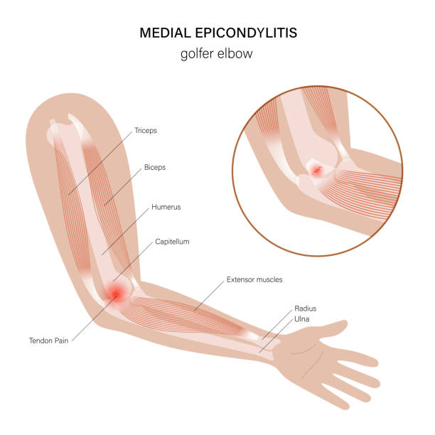 illustrazioni stock, clip art, cartoni animati e icone di tendenza di gomito da golfista epicondilite mediale - human muscle human arm muscular build body building