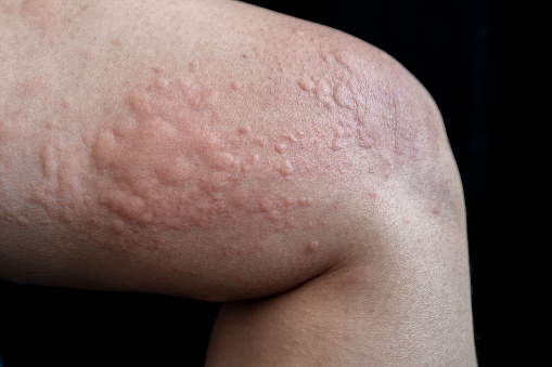 Urticaria Stock Photo - Download Image Now - Hives - Skin Condition, Skin,  Skin Condition - iStock