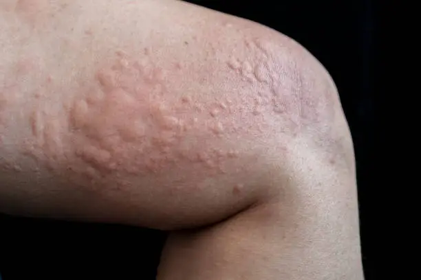 Photo of Urticaria