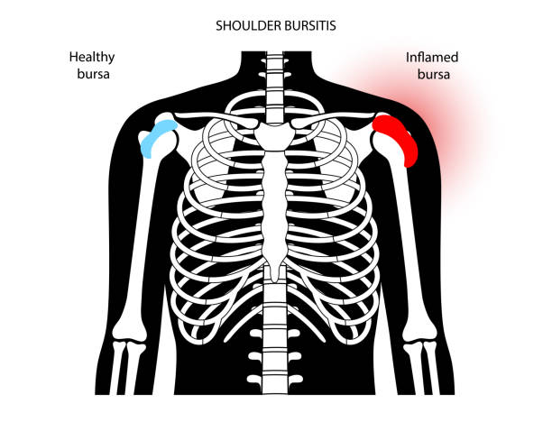 Bursitis inflammation concept Shoulder bursitis inflammation ripl fitness