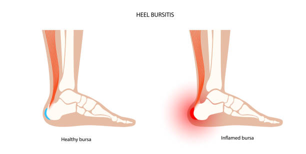 Bursitis inflammation concept Heel bursitis inflammation. Inflamed bursa in human ankle. Achilles tendon and foot disease, pain and deformity. Diagnosis and treatment. Anatomical musculoskeletal poster, medical vector illustration deformed stock illustrations