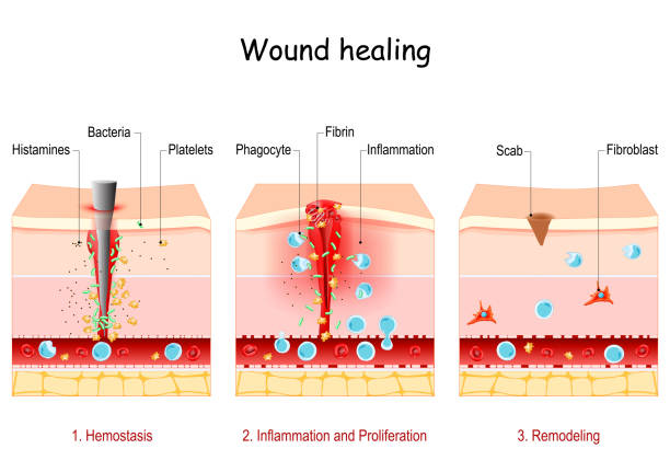 illustrazioni stock, clip art, cartoni animati e icone di tendenza di guarigione delle ferite. fasi del processo di riparazione post-trauma. - ferito