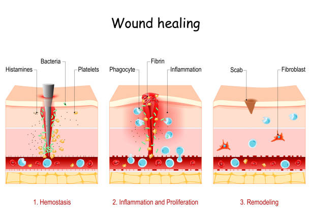 wound healing. Stages of the post-trauma repairing process. wound healing. Stages of the post-trauma repairing process. Hemostasis, Inflammatory, Proliferative, and remodeling phase. Cross section of a layers of the human skin wounded stock illustrations