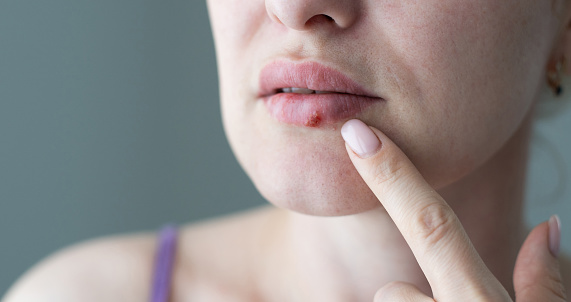 La mujer con un virus herpes en los labios photo