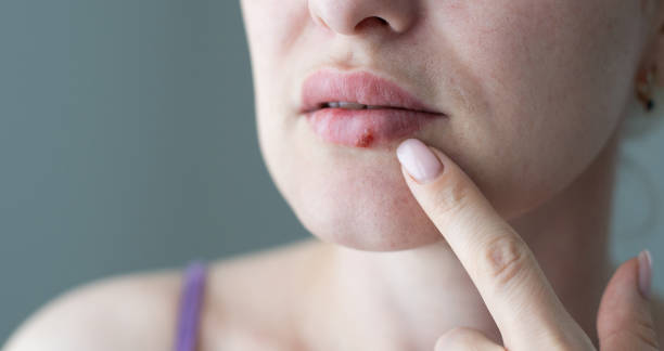 The woman with a virus herpes on lips stock photo