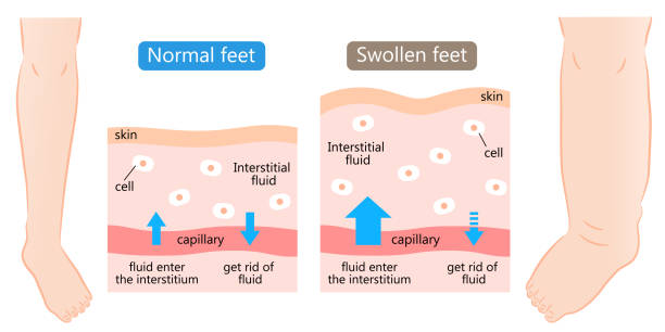 皮膚図で腫れ、正常な足。腫れは��、体の組織内の余分な流体によって引き起こされます。イラストの後の前。ヘルスケアの概念 - 水腫点のイラスト素材／クリップアート素材／マンガ素材／アイコン素材