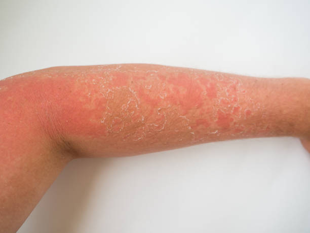 istock sunburn on the skin, severe tan on the arm 1328210508