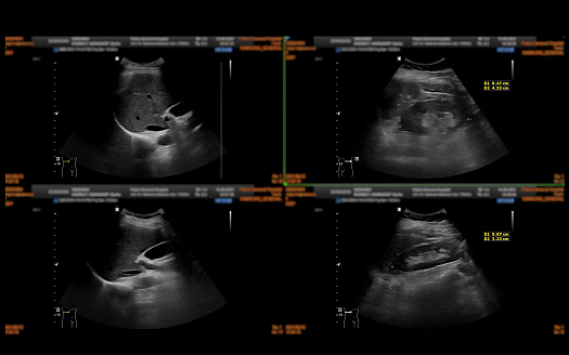 Ultrasound upper abdomen showing  Liver, gall bladder and kidney for screening abdominal disease.
