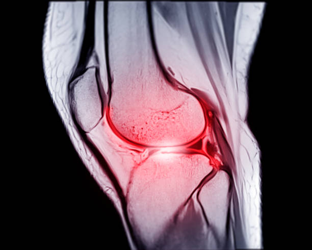 magnetresonanztomographie oder mrt knie sagittale pdw und tiw ansicht zur erkennung von riss oder verstauchung des vorderen kreuzbandes (acl). - cruciate ligament stock-fotos und bilder