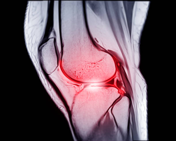 Magnetic resonance imaging or MRI knee sagittal PDW and TIW view for detect tear or sprain of the anterior cruciate  ligament (ACL). stock photo