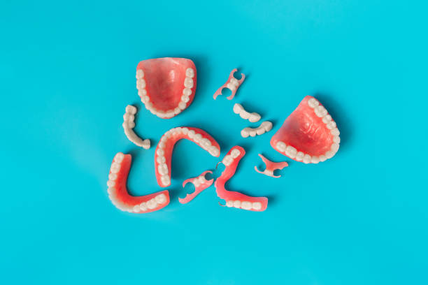 dental prosthetics on a blue background. dentures. prosthetic teeth. false teeth. prosthetic dentistry. set of dentures on a blue background. top view of complete denture on blue background - dentures imagens e fotografias de stock