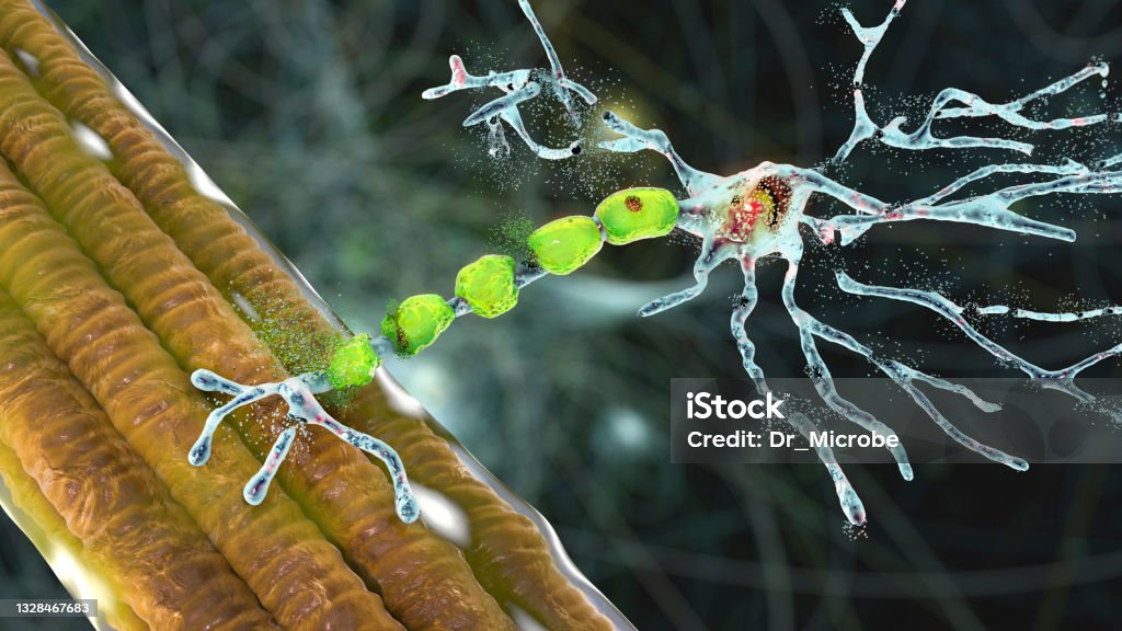 Degradation of motor neurons, conceptual 3D illustration Degradation of motor neurons, conceptual 3D illustration. Motor neuron diseases are a group of neurodegenerative disorders including amyotrophic lateral sclerosis, progressive bulbar palsy and other Amyotrophic Lateral Sclerosis Stock Photo