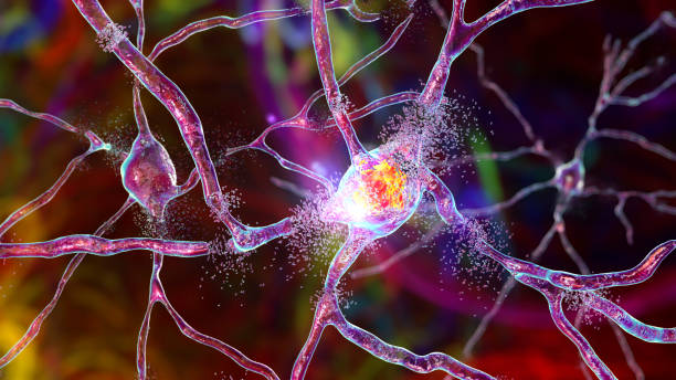 등쪽 조각의 뉴런 파괴, 개념적 3d 일러스트 - nerve cell 뉴스 사진 이미지