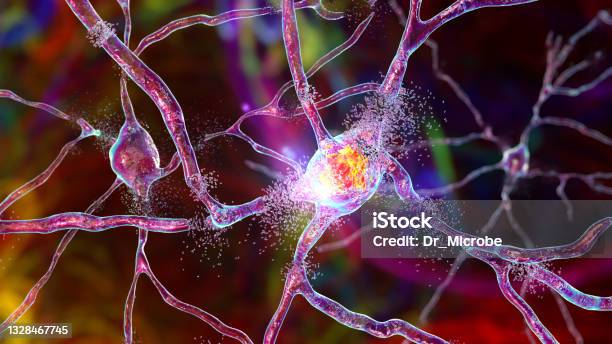 Destruction Of Neurons Of Dorsal Striatum Conceptual 3d Illustration Stock Photo - Download Image Now
