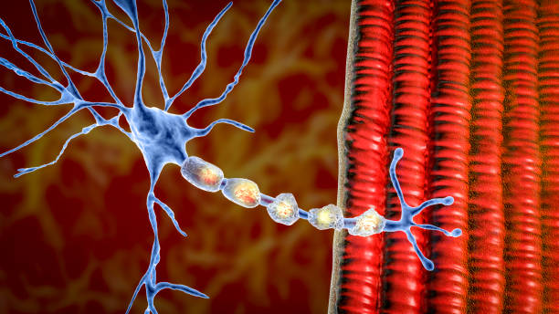 Demyelination of a neuron, the damage of the neuron myelin sheath seen in demyelinating diseases Demyelination of neuron, the damage of the neuron myelin sheath seen in demyelinating diseases, 3D illustration. Multiple sclerosis and other demyelinating myelinoclastic and leukodystrophic diseases medulla stock pictures, royalty-free photos & images