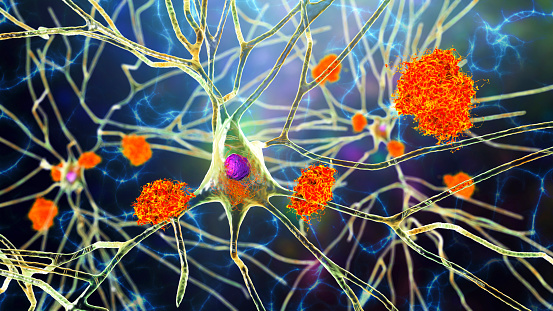 Neurons in Alzheimer's disease. 3D illustration showing amyloid plaques in brain tissue, neurofibrillary tangles and distruction of neuronal networks