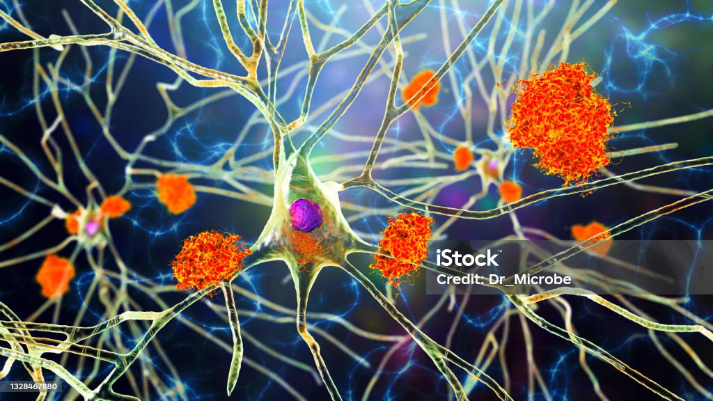 Neurons in Alzheimer's disease. Illustration showing amyloid plaques in brain tissue Neurons in Alzheimer's disease. 3D illustration showing amyloid plaques in brain tissue, neurofibrillary tangles and distruction of neuronal networks Amyloid Stock Photo