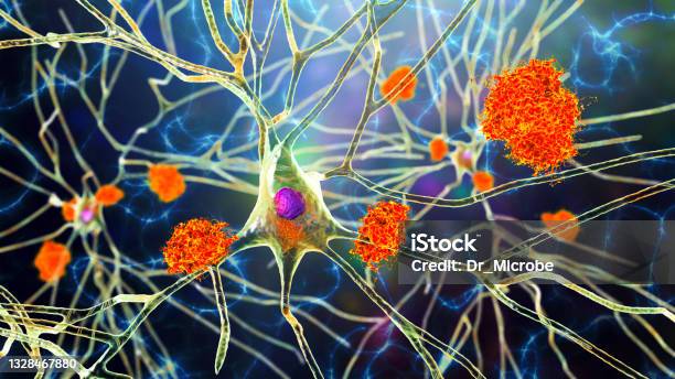 Neurons In Alzheimers Disease Illustration Showing Amyloid Plaques In Brain Tissue Stock Photo - Download Image Now