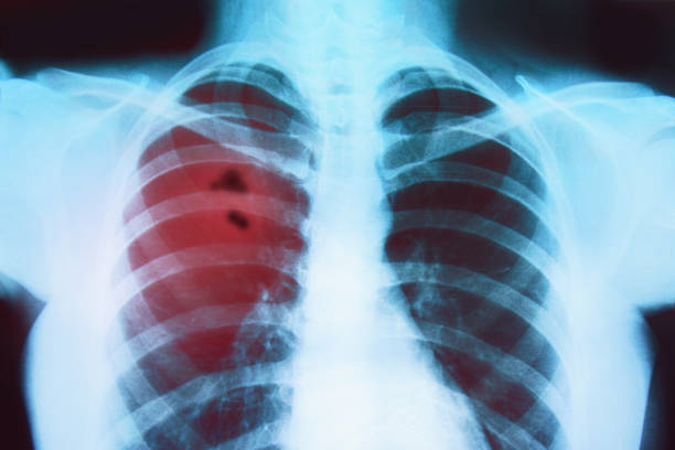 radiografia dei polmoni di una persona malata - human lung asthmatic x ray human internal organ foto e immagini stock
