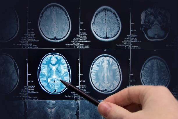 istock Brain research, magnetic resonance imaging 1328513395