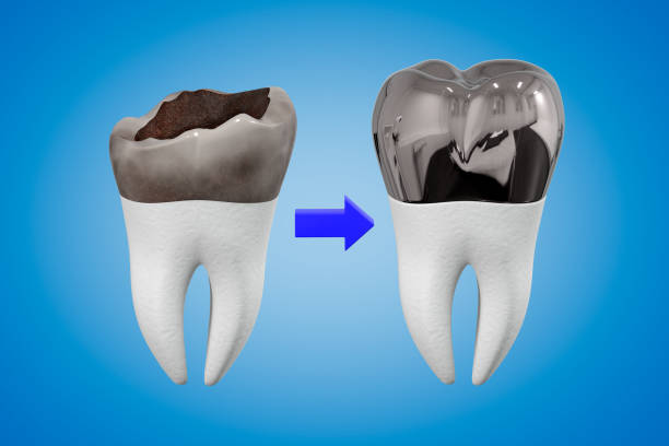 The concept of prosthetics of a damaged tooth with a metal crown. Carious tooth and dental crown. 3d rendering. The concept of prosthetics of a damaged tooth with a metal crown. Carious tooth and dental crown. Dental theme. 3d rendering. dental crown stock pictures, royalty-free photos & images