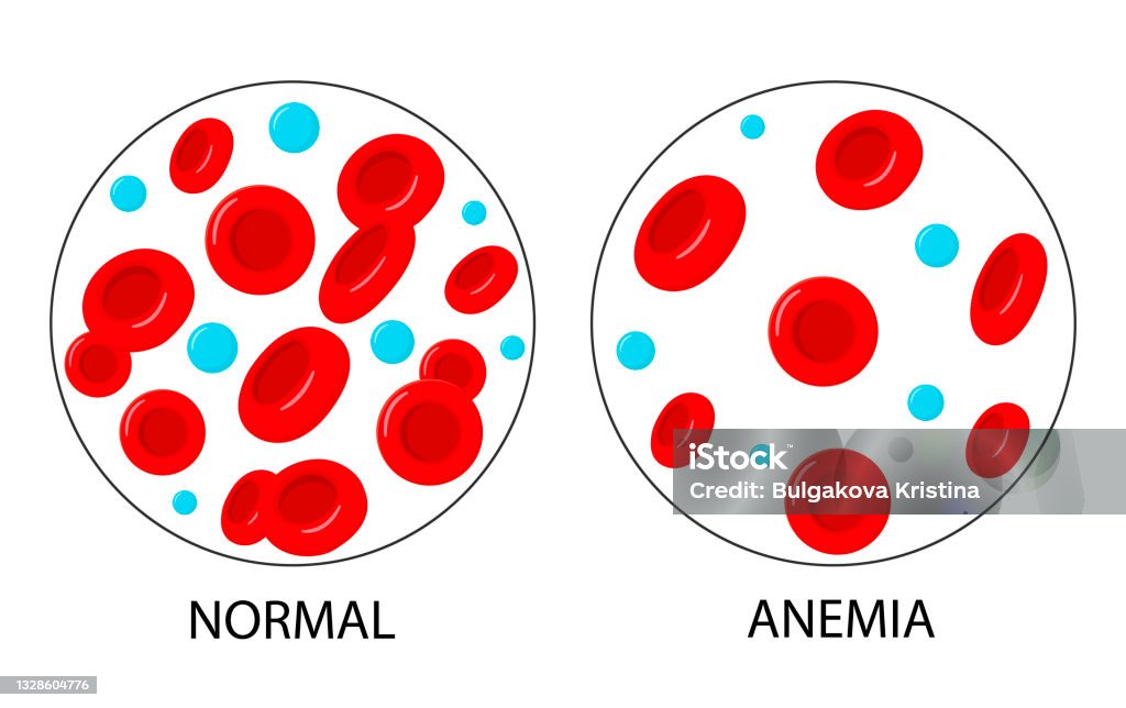 Anemia Defisiensi Besi Perbedaan Jumlah Anemia Sel Darah Merah Dan ...