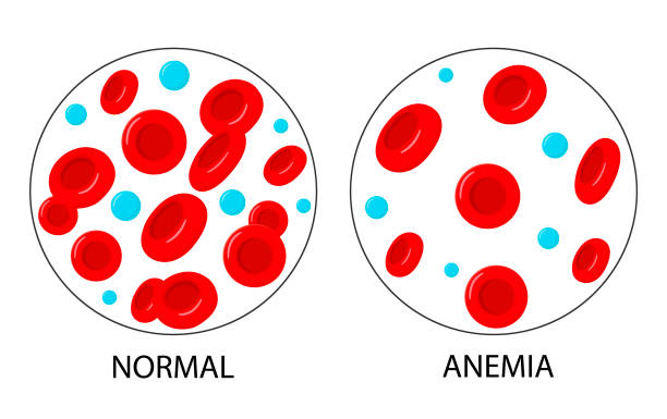 Iron deficiency anemia.The difference of Anemia amount of red blood cell and normal. Iron deficiency anemia.The difference of Anemia amount of red blood cell and normal. anemia diagram stock illustrations