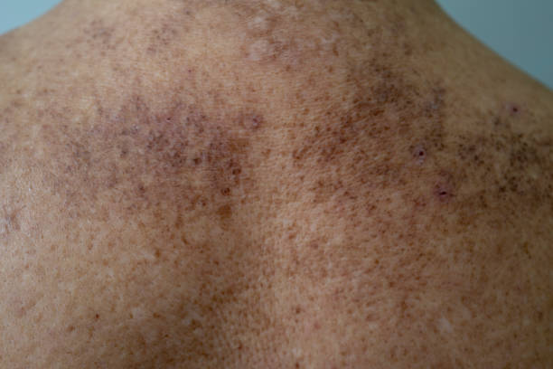 istock Skin amyloidosis 1328628398