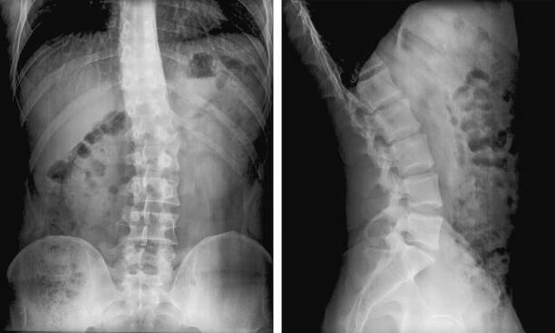 脊椎湾曲(脊柱側弯症)のx線フィルム。重度の医学的脊柱側弯症。レントゲンスキャンを放射線撮影で患者を診断する。 - pain rib cage x ray image chest ストックフォトと画像