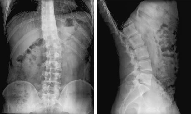 X-ray film of spinal curvature (Scoliosis). Severe medical scoliosis. Diagnosing patient with radiography roentgen scan. stock photo