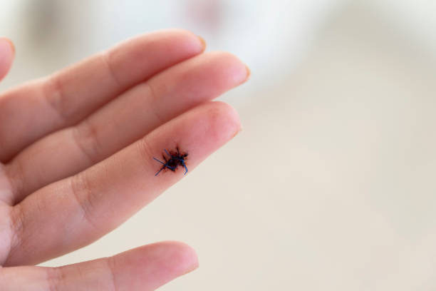 istock A wound on a woman's finger was treated with surgical sutures. 1328710453