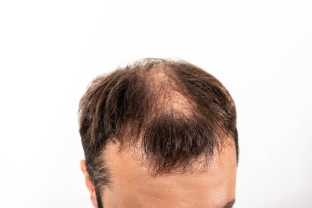 istock Close-up balding head of a young man on a white isolated background 1328804402