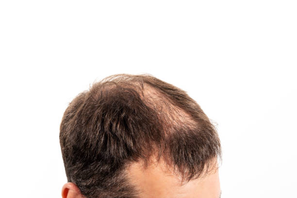 istock Close-up balding head of a young man on a white isolated background 1328804421