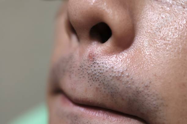 istock Acne under the nose of a man 1328866336