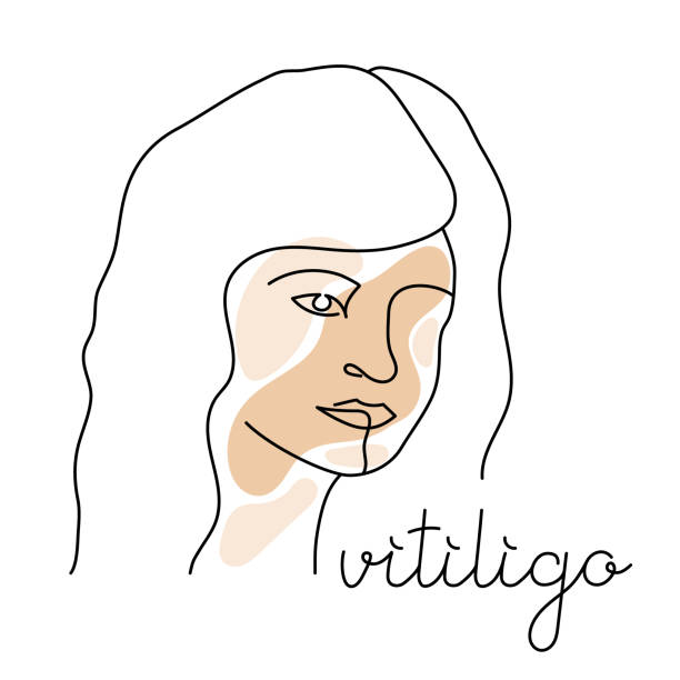 Vitiligo Person illustration clipart. Outline portrait art. International vitiligo day. Simple line art woman face with skin problems. Outline Person clipart. Abstract portrait girl in hat. vitiligo stock illustrations