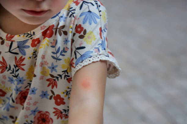 istock Mosquito or insect bite on child's arm 1328894757