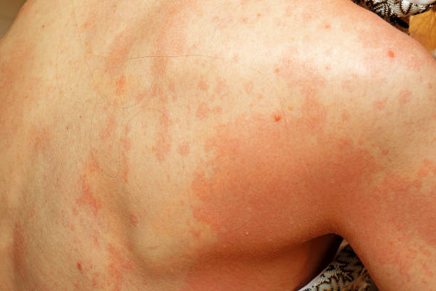 istock Severe allergic reaction on skin 1328907236