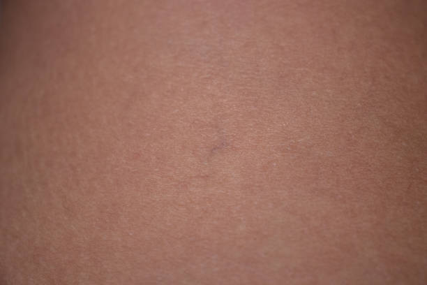 istock Small vascular spider on the skin 1328995846