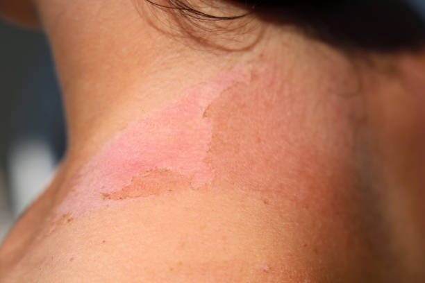 niebezpieczne konsekwencje oparzenia słoneczne na ramionach młodej dziewczyny, zaczerwienienie skóry z uszkodzonymi obszarami skóry - unwell one person suntan lotion danger zdjęcia i obrazy z banku zdjęć