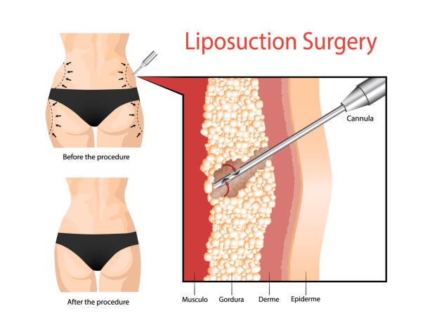 liposukcja. operacja czyszczenia warstwy tłuszczu pod skórą. - liposuction stock illustrations