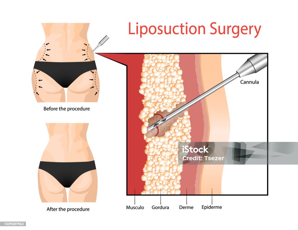 Liposuction The Operation To Clean The Fat Layer Under The Skin Stock  Illustration - Download Image Now - iStock