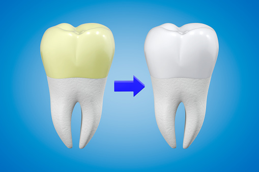 New, artificial teeth, upper jaw