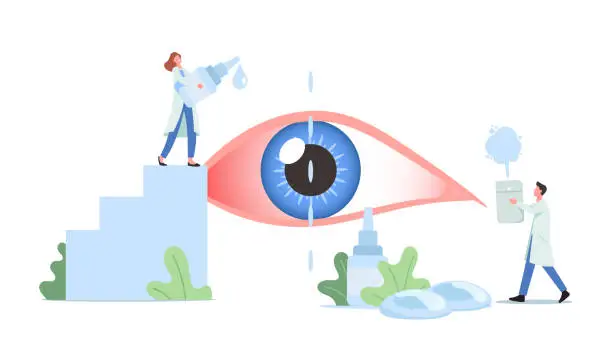 Vector illustration of Tiny Doctors Characters Dripping Drops in Huge Human Eye Suffering of DES, Dry Eyes Syndrome and Conjunctivitis Disease