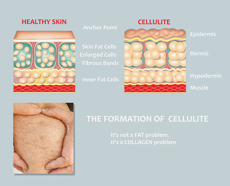 Forming of underskin cellulite illustration. Structure of normal healthy and cellulite skin. Comparison