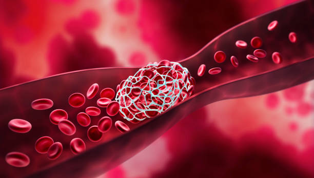 Blood Clot Blood clot blocking a blood vessel and blood stream - 3D illustration blood clot stock pictures, royalty-free photos & images